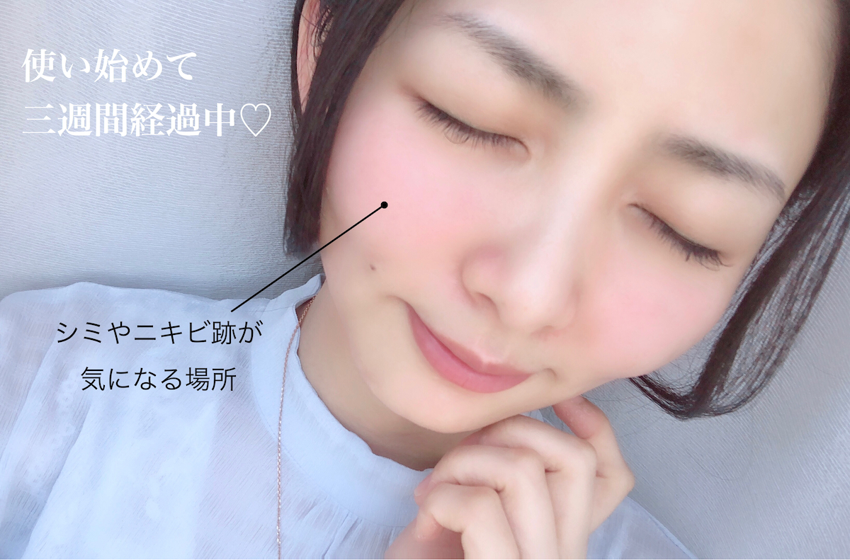 念願の【青山ヒフ科クリニック】の感想！自宅ケア3週間経過中